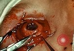 Image of ocular enucleation United States USA, 1945, second 52 stock footage video 65675077561