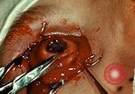 Image of ocular enucleation United States USA, 1945, second 53 stock footage video 65675077561