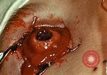 Image of ocular enucleation United States USA, 1945, second 54 stock footage video 65675077561