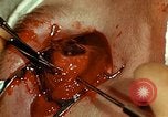 Image of ocular enucleation United States USA, 1945, second 55 stock footage video 65675077561