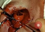 Image of ocular enucleation United States USA, 1945, second 56 stock footage video 65675077561