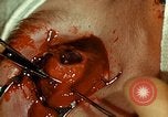 Image of ocular enucleation United States USA, 1945, second 57 stock footage video 65675077561