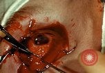 Image of ocular enucleation United States USA, 1945, second 58 stock footage video 65675077561
