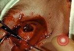 Image of ocular enucleation United States USA, 1945, second 59 stock footage video 65675077561