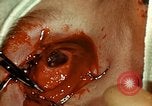 Image of ocular enucleation United States USA, 1945, second 60 stock footage video 65675077561