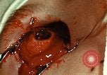 Image of ocular enucleation United States USA, 1945, second 61 stock footage video 65675077561