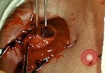 Image of ocular enucleation United States USA, 1945, second 62 stock footage video 65675077561