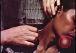 Image of fallout victims examined Bikini Atoll Marshall Islands, 1954, second 61 stock footage video 65675078698