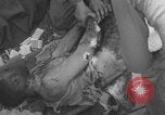 Image of USA soldier burn victim treated WW2 Saint Lo France, 1944, second 33 stock footage video 65675079320