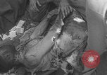 Image of USA soldier burn victim treated WW2 Saint Lo France, 1944, second 36 stock footage video 65675079320