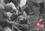 Image of USA soldier burn victim treated WW2 Saint Lo France, 1944, second 45 stock footage video 65675079320