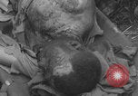 Image of USA soldier burn victim treated WW2 Saint Lo France, 1944, second 53 stock footage video 65675079320