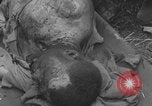 Image of USA soldier burn victim treated WW2 Saint Lo France, 1944, second 57 stock footage video 65675079320
