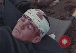 Image of Iwo Jima blood transfusion Iwo Jima, 1945, second 49 stock footage video 65675080625
